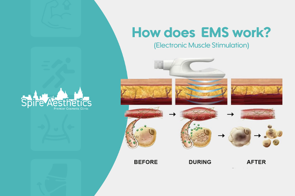 EMS treatment for post pregnancy weight loss treatment Cheshire