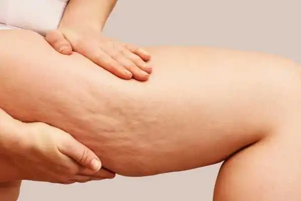 Image of woman showing leg with cellulite Cheshire
