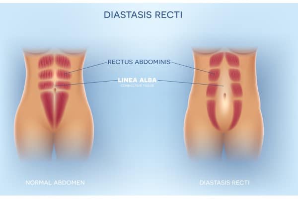 What Non-Surgical Options Are Available for Diastasis Recti Cheshire?