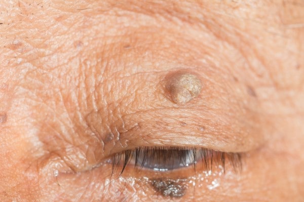 Skin imperfections Cheshire - Cryopen is fast and effective book in today!