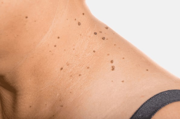 Are you looking for easy skin tag removal Cheshire - then contact Spire today!