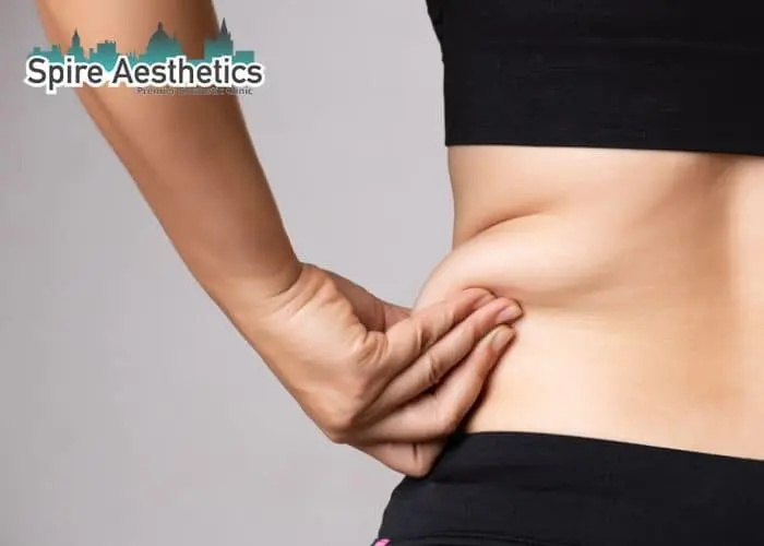 Image of woman pinching fat on their hips Cheshire. Fat Freezing treatment