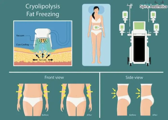 Fat freezing treatment Cheshire benefits for competitions to remove stubborn fat deposits.