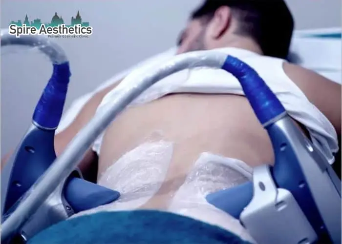 Man having fat freezing treatment done on love handles before a competitions Cheshire to create a sculpted look.