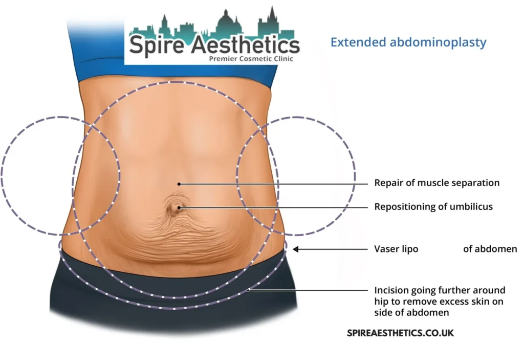 Understanding Loose Skin After Gastric Band Cheshire Surgery and HIFU Treatment 