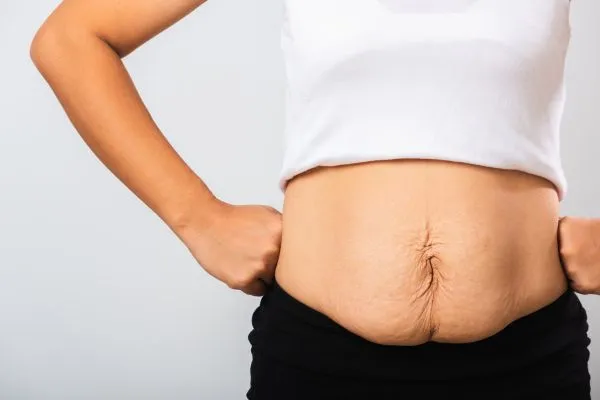 Image of a woman's stomach after weight loss with sagging skin following a gastric band Cheshire