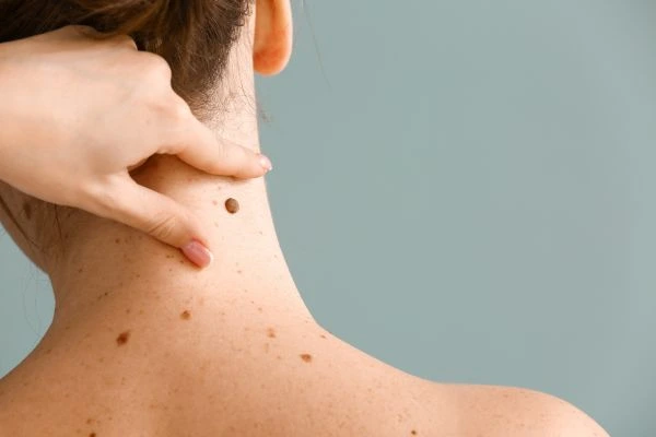 Prices and promotions for blemish removal Cheshire contact our team today!