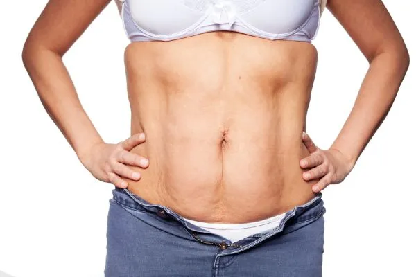 sagging skin on woman's stomach after weight loss injections Cheshire
