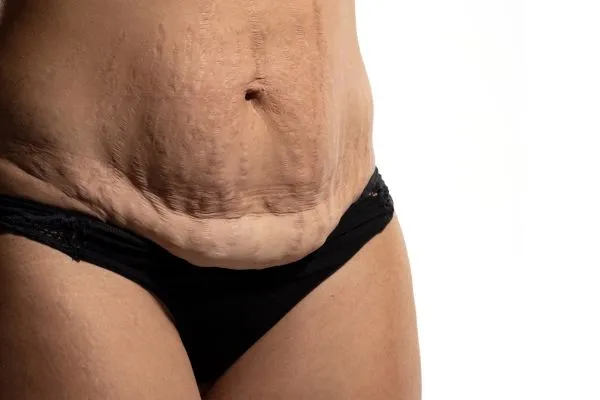 Image of womans stomach after weight loss injections Cheshire showing saggy skin