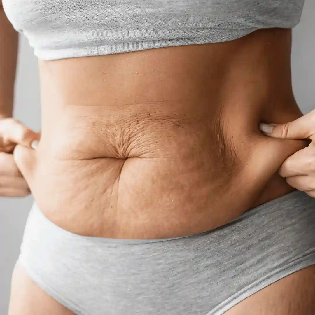 Is It Normal to Have Loose Skin After Pregnancy Cheshire?
