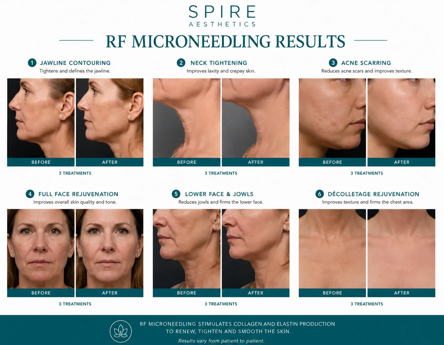 RF Microneedling Skin tightening Cheshire results