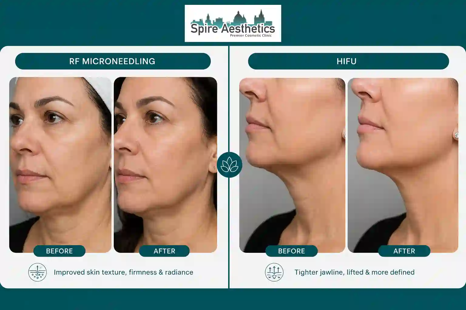 Can RF Microneedling and HIFU Be Combined Cheshire?