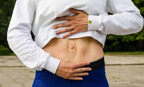 When Could Diastasis Recti Be the Missing Piece of the Puzzle Cheshire?