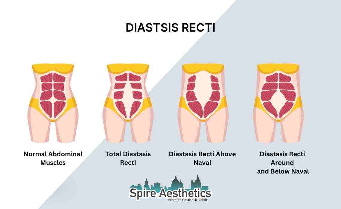 Is Non-Surgical Diastasis Recti Treatment Right for You? Common Concerns Answered Cheshire
